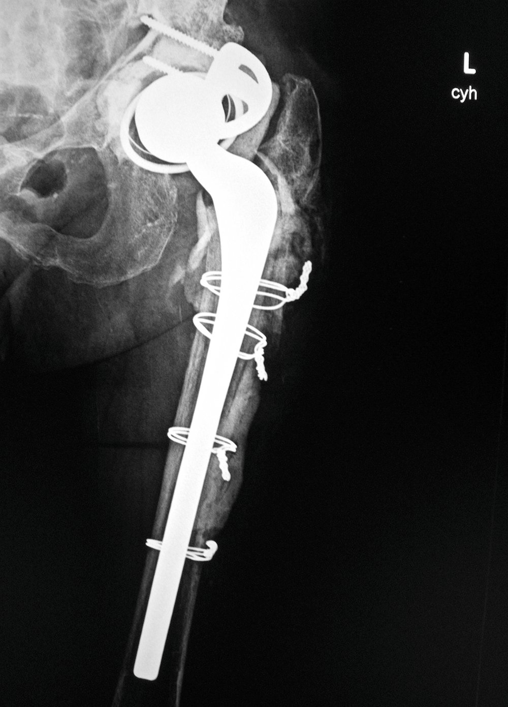 F5