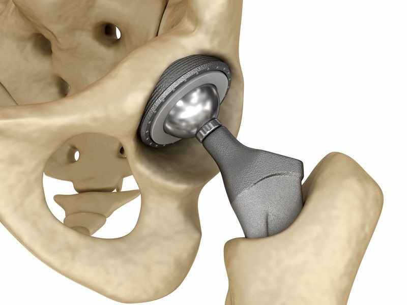 Hip-and-Implant